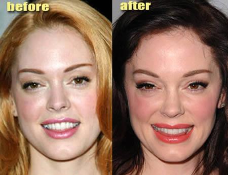 Rose McGowan Roza bija... Autors: Khalifa 12 Sliktākās plastiskās operācijas