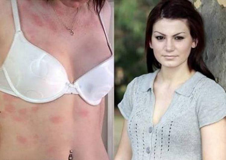 Alerģija pret... Autors: Lestets 10 cilvēki ar neticamām diagnozēm