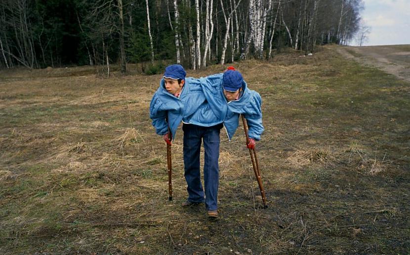 Dvīnes nomira ar 17 stundu... Autors: Artemiis Viena bija psihopāte, otra – empāte | Siāmas dvīņu Mašas un Dašas skaudrā dzīve