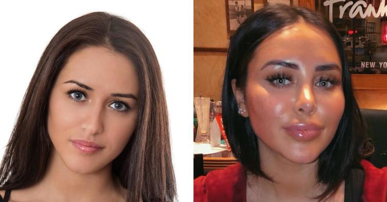 Autors: matilde Cilvēki, kuri vēlējās sev lielas lūpas, bet kaut kas nogāja greizi