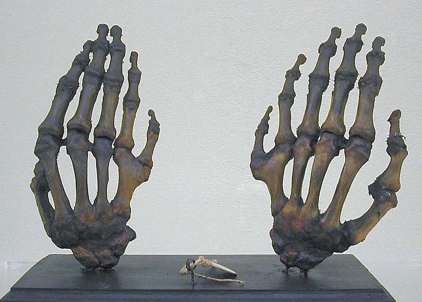 Daudzpirkstība jeb... Autors: The Diāna Izglītojoši: Neparasti skeleti, kuri ilustrē slimības un procesus