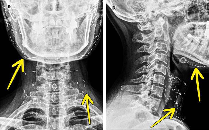 Pacientam bija sejas ādas... Autors: Lestets 15 rentgenuzņēmumi, kas atklās par ķermeni vairāk nekā anatomijas grāmatas