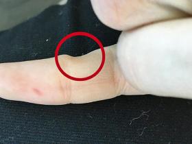 Nepareiza telefona tūrēšana beidzas ar deformētiem mazajiem pirkstiņiem